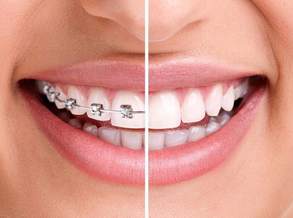 Clear aligners comparison showing cost savings