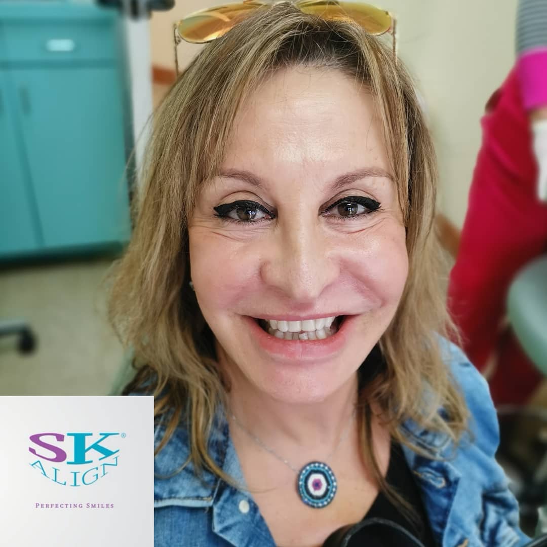 Clear aligner fitting process