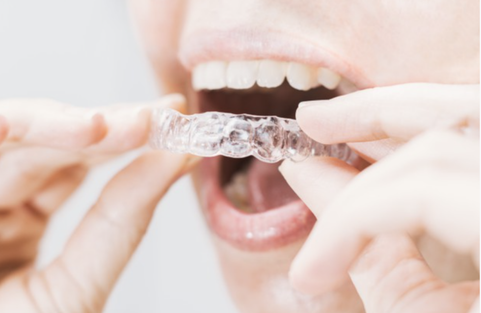 Am I a candidate for clear aligners?